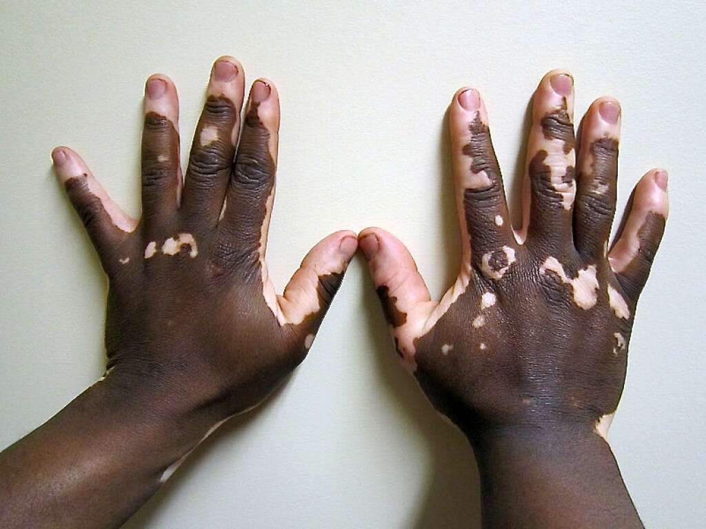 Vitiligo