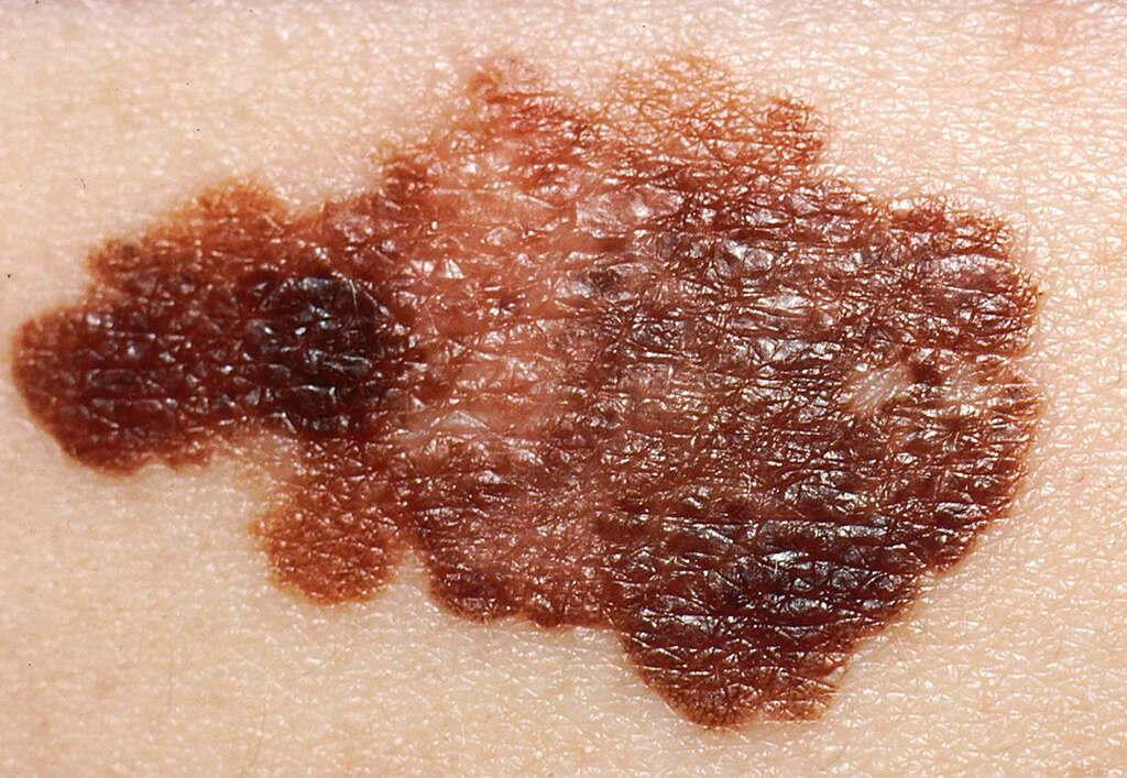 Vulvar Cancer