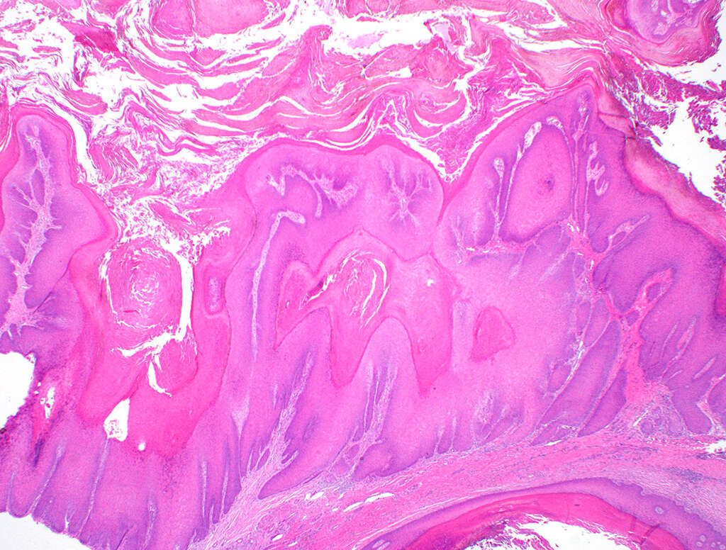 Vulvar Cancer