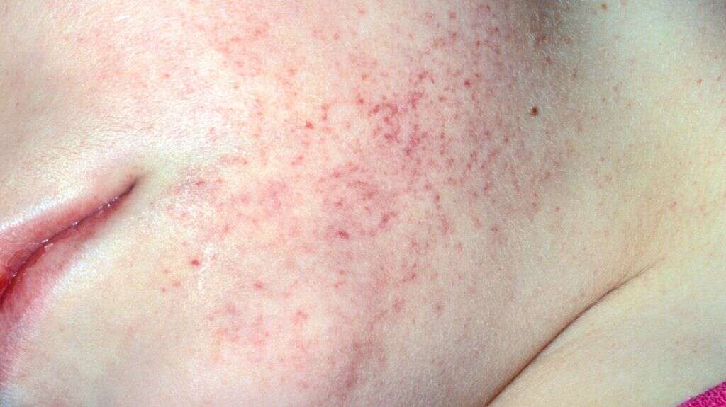 Capillaries
