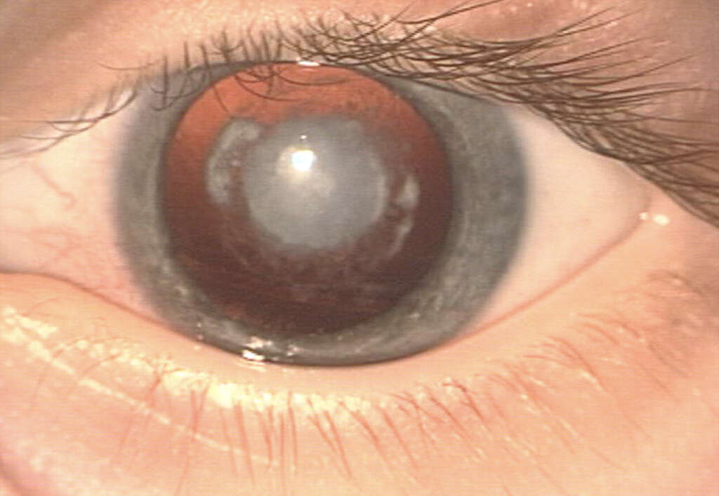 Cataracts