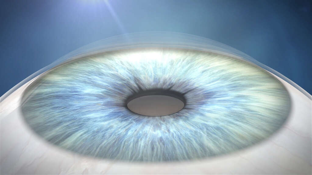 Cataracts
