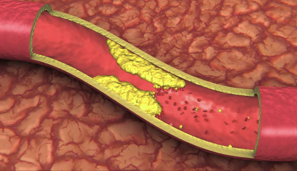 Clogged Arteries