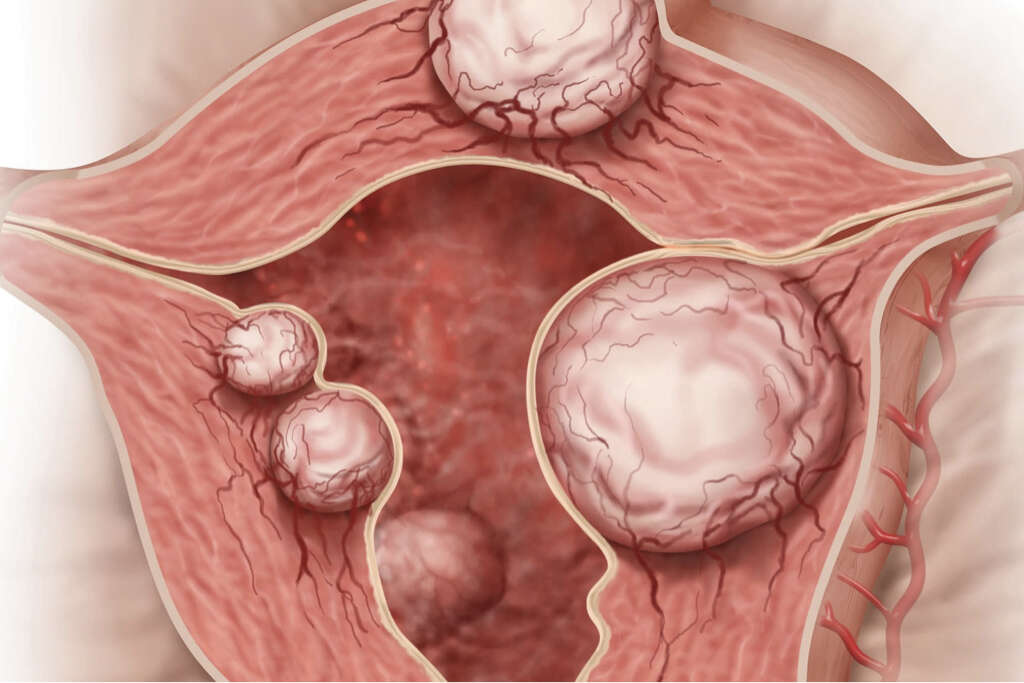 Fibroids What Are Fibroids 