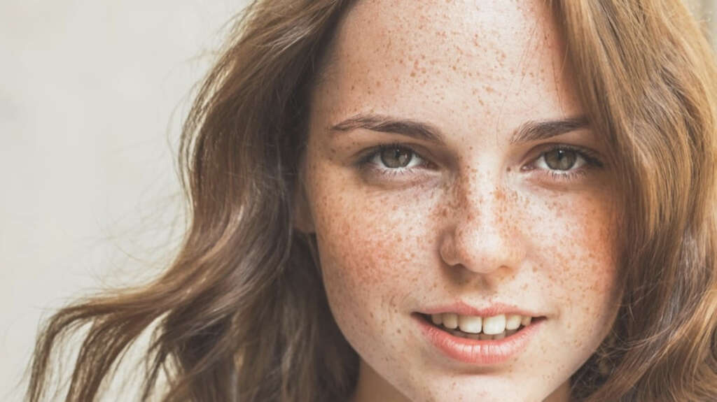 Freckles