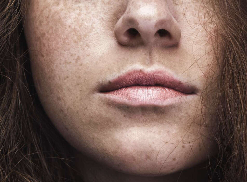 Freckles