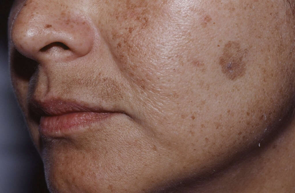 Freckles