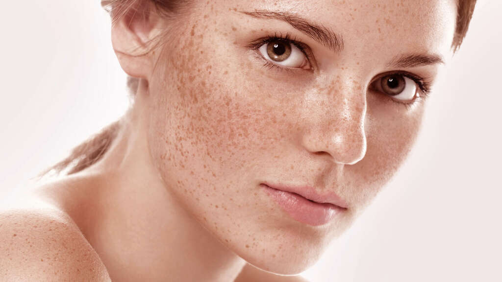 Freckles