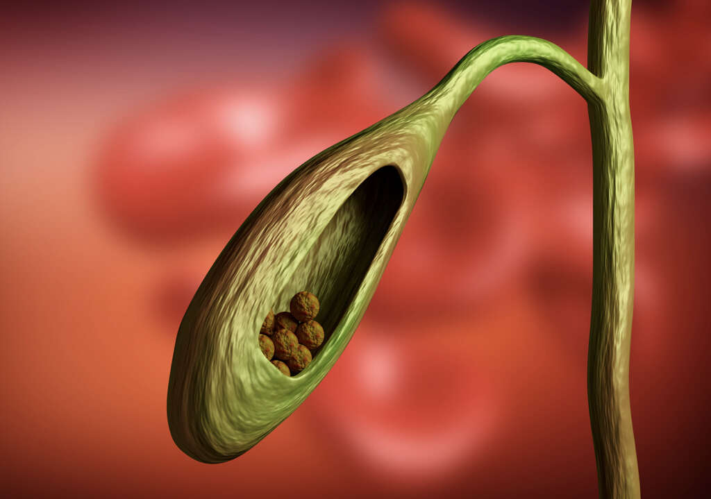Gallbladder Stones