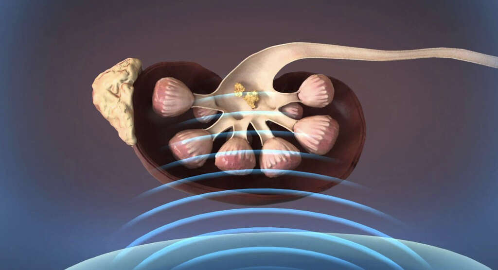 Gallbladder Stones
