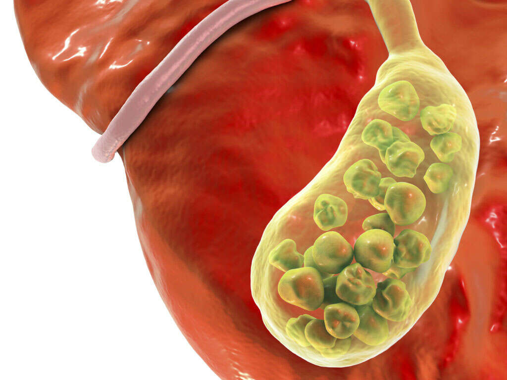Gallstones