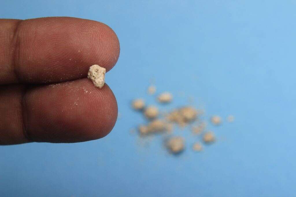 Gallstones