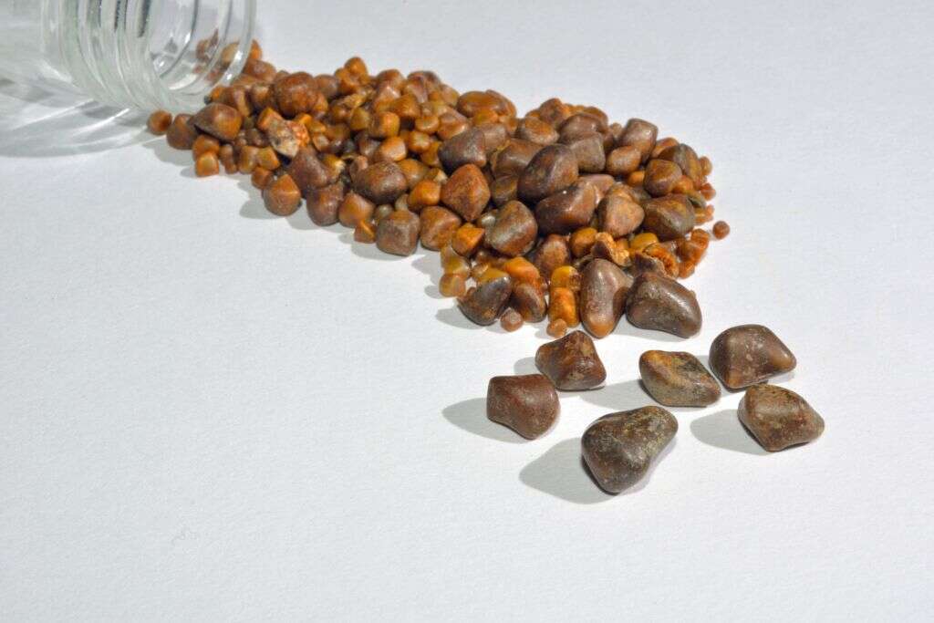 Gallstones