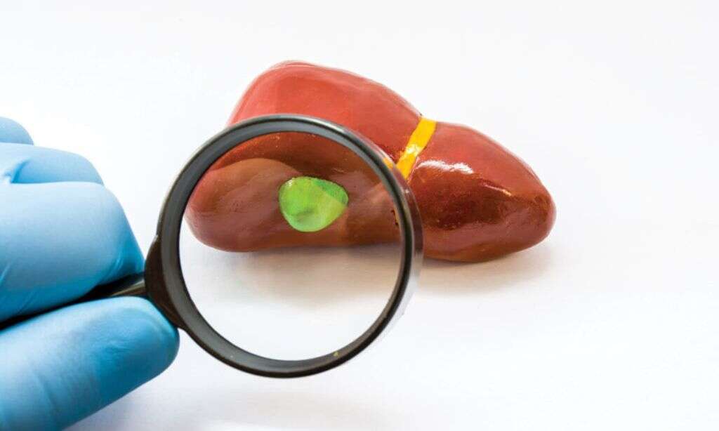Gallstones