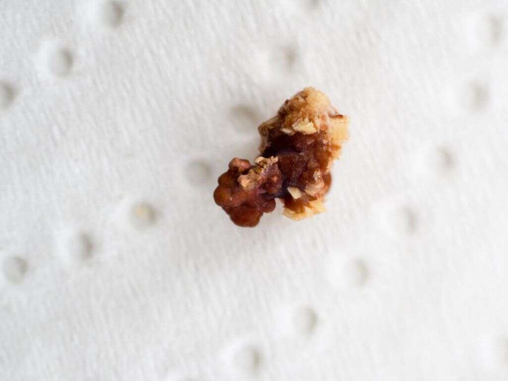 Kidney Stones