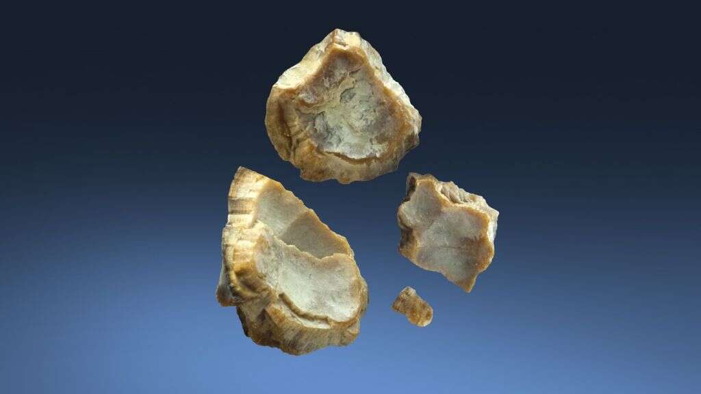 Kidney Stones