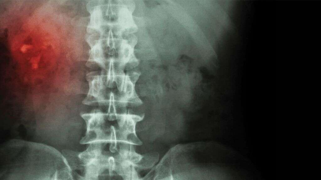 Kidney Stones