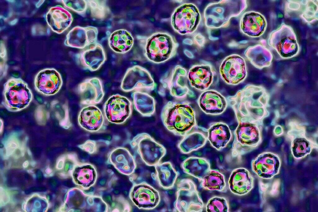 Measles