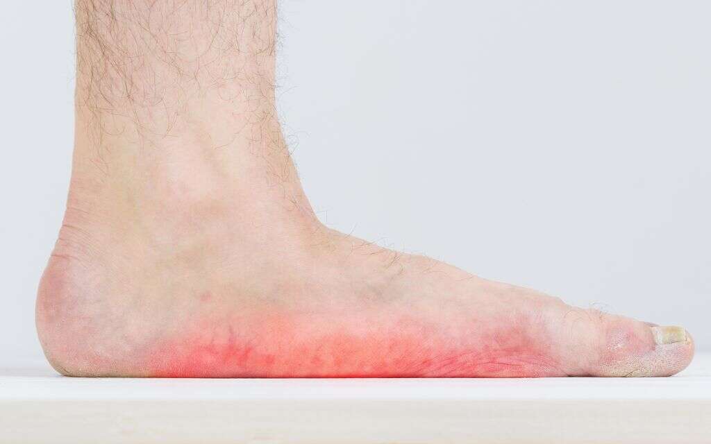 Shin Splints