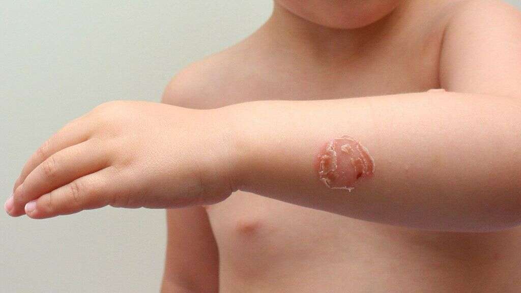 Skin Infections