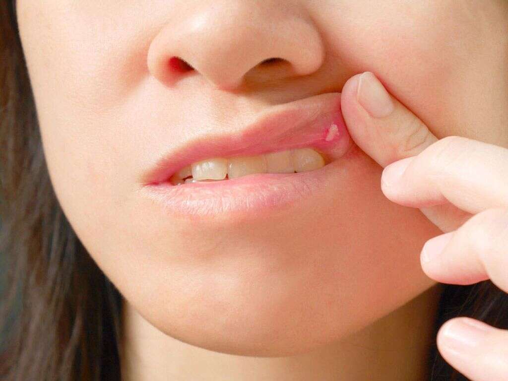 Lupus