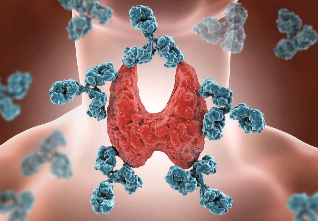 Thyroid Nodules