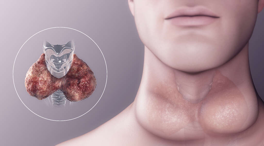 Thyroid Nodules