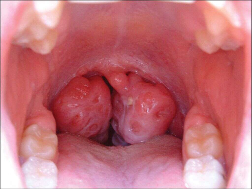 Tonsil Stones