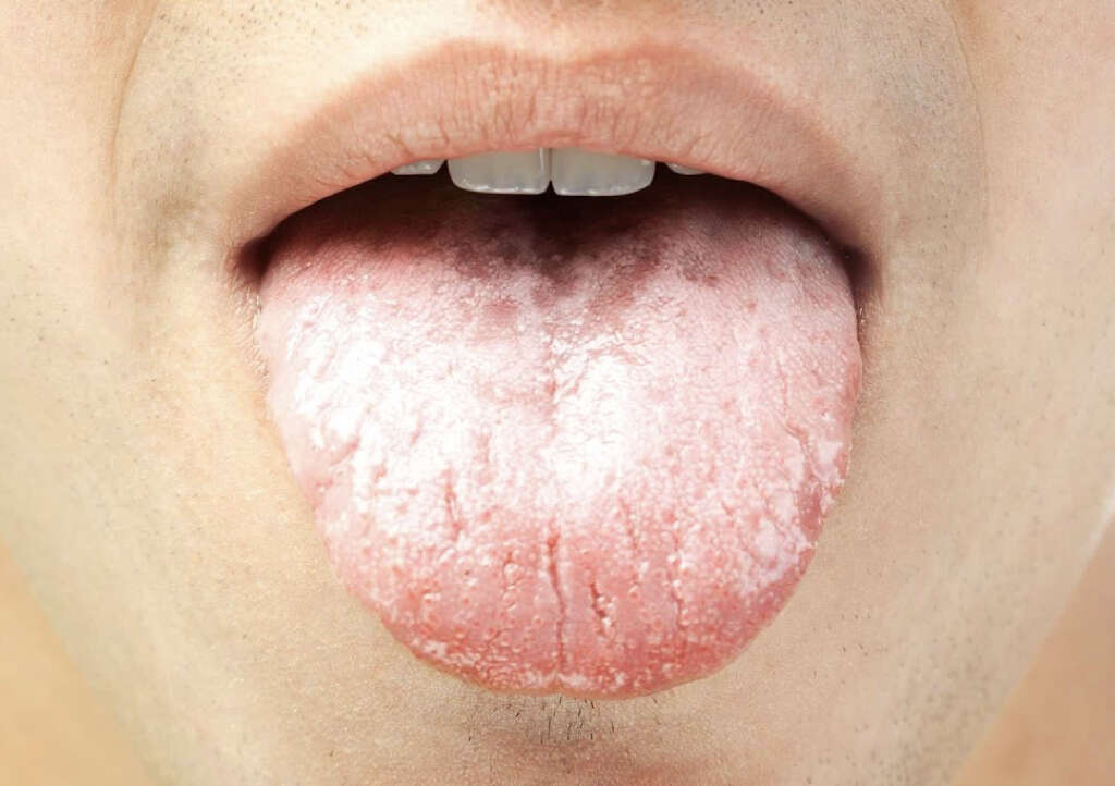 White Spots On Tonsils