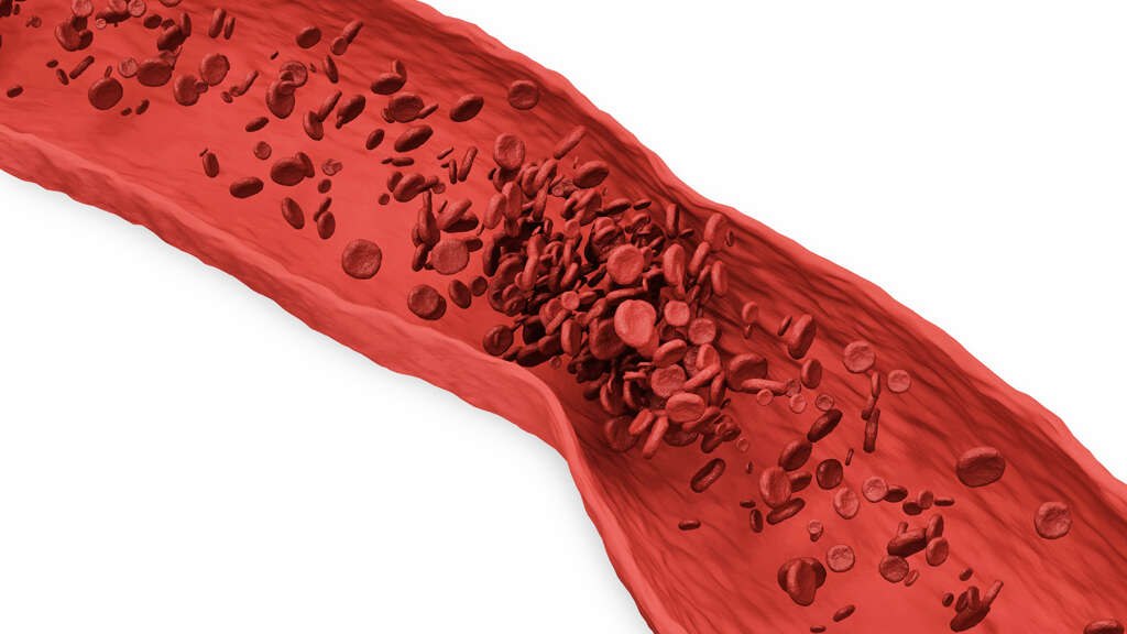 Blood Clots