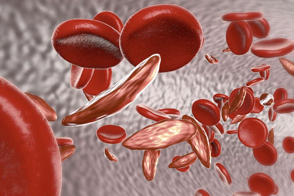 Blood Clots