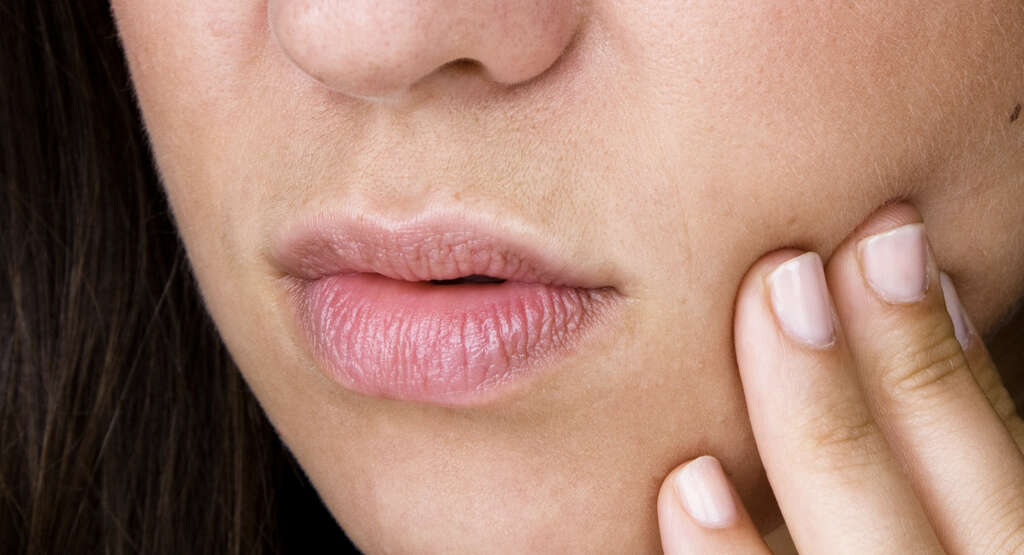Canker Sores