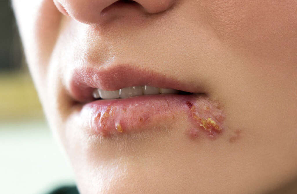 Canker Sores