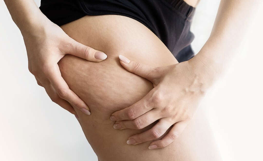 Cellulite