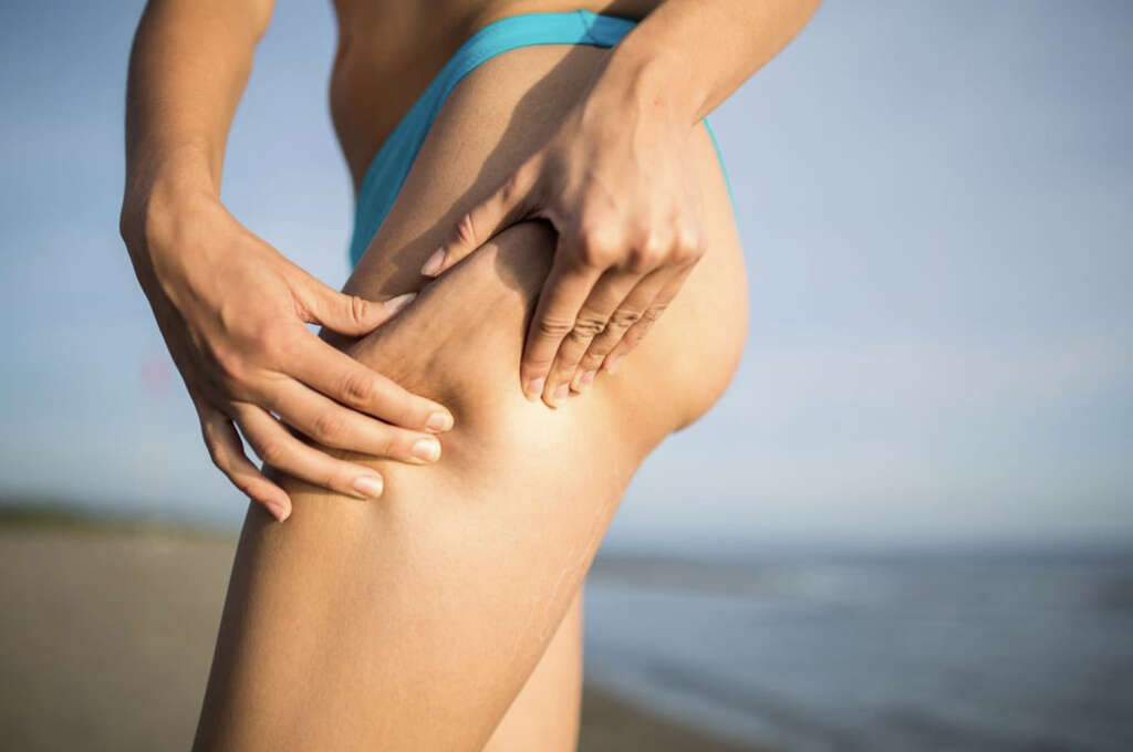 Cellulite