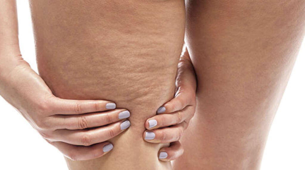 Cellulite