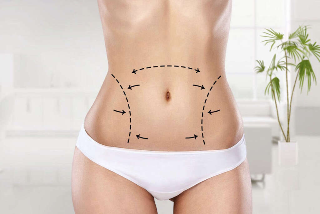 Cellulite