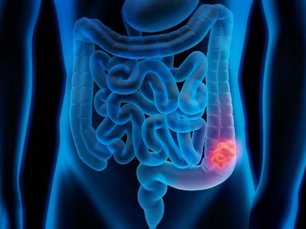 Colon Cancer
