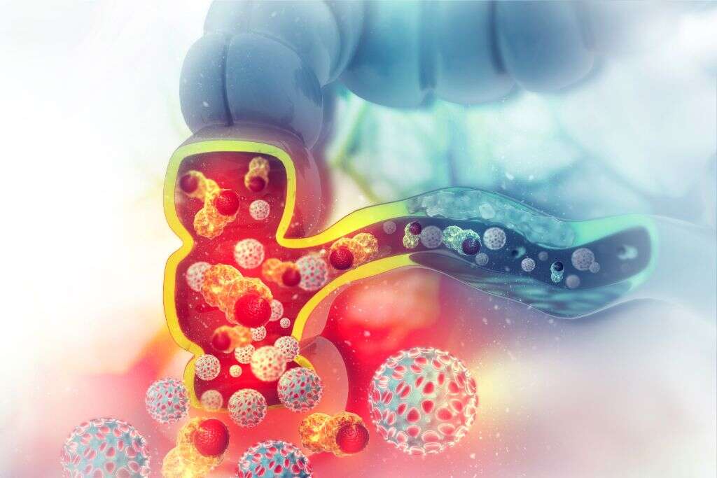 Colon Cancer