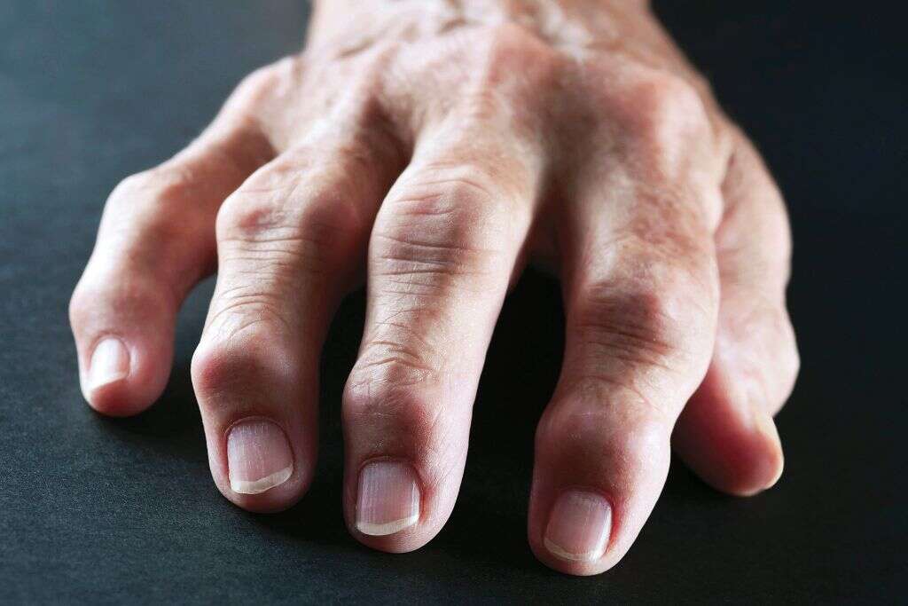 Gout