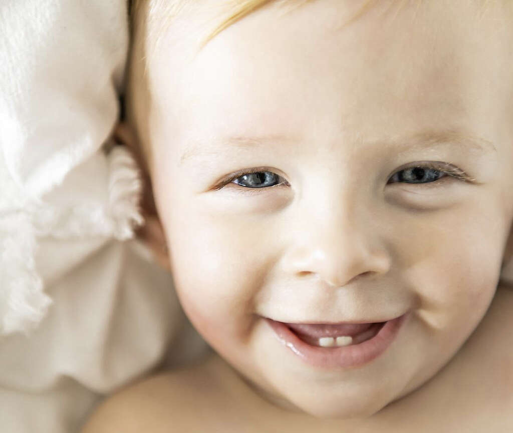 Jaundice in Babies