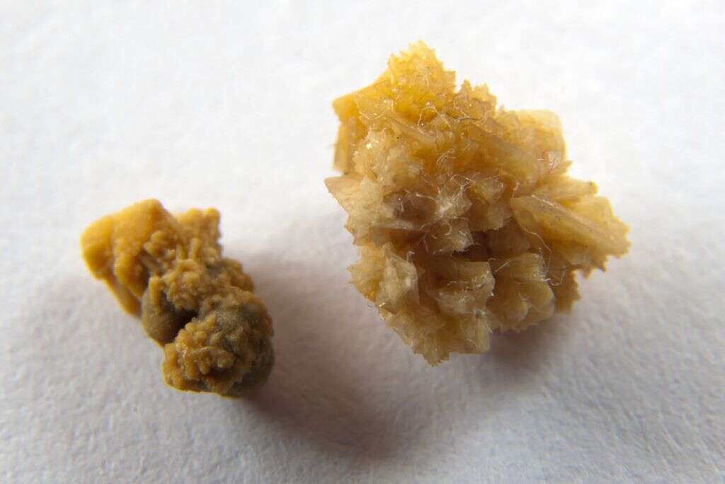 Kidney Stones