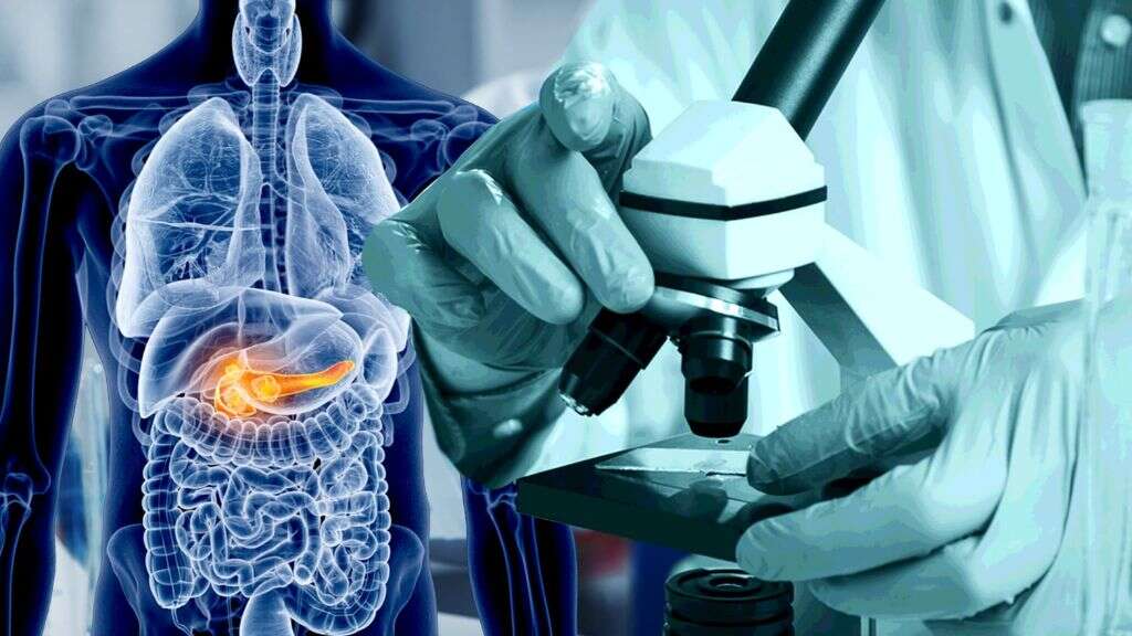 Pancreatic Cancer