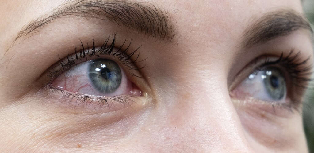 Pink Eye