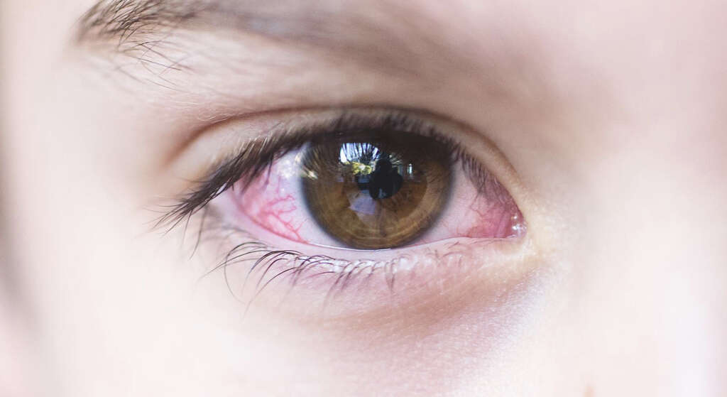 Pink Eye