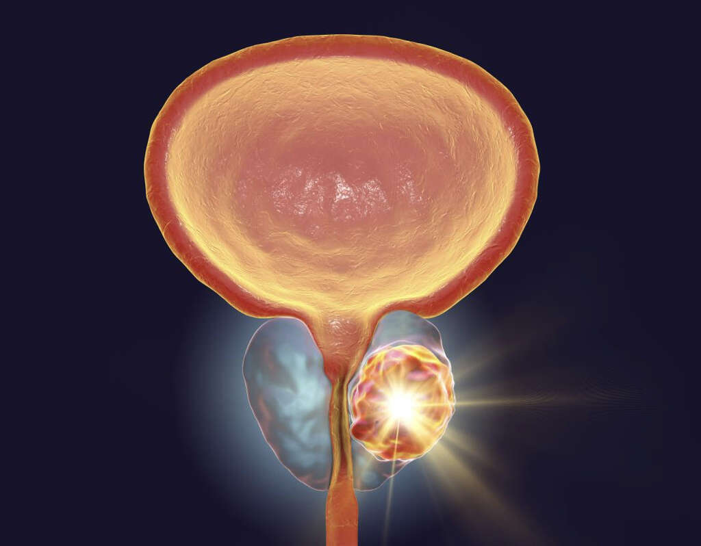 Prostate Cancer