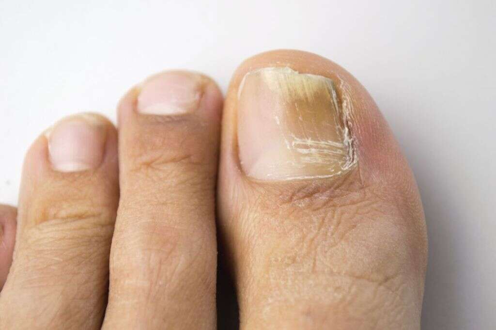 Toenail Fungus