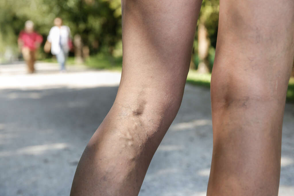 Varicose Veins