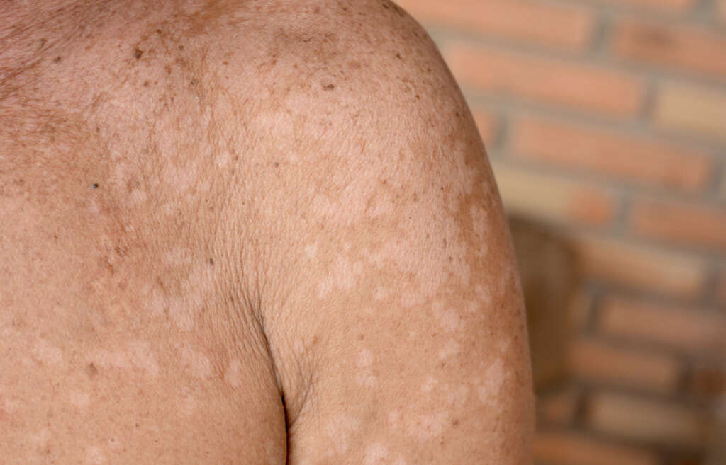 White Spots On Skin