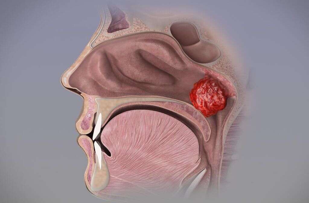 Tonsils